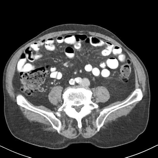 File:Amyand hernia (Radiopaedia 39300-41547 A 44).png