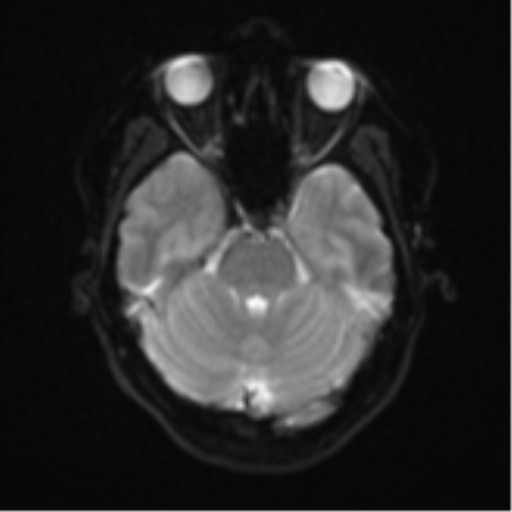 Anaplastic astroblastoma (Radiopaedia 55666-62194 Axial DWI 9).png