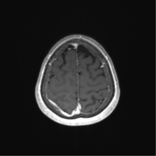 File:Anaplastic astrocytoma (Radiopaedia 86943-103160 Axial T1 C+ 75).png