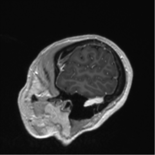 Anaplastic astrocytoma IDH mutant (Radiopaedia 50046-55341 Sagittal T1 C+ 14).png