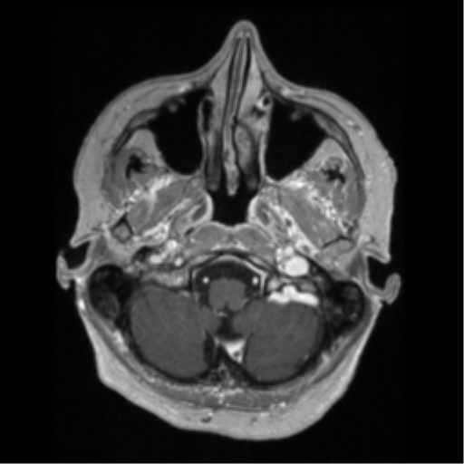 File:Anaplastic astrocytoma IDH wild-type (pseudoprogression) (Radiopaedia 42209-45276 Axial T1 C+ 25).png
