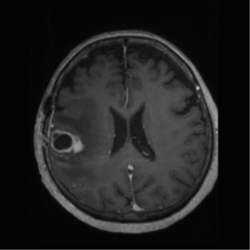 File:Anaplastic astrocytoma IDH wild-type (pseudoprogression) (Radiopaedia 42209-45277 Axial T1 C+ 78).png