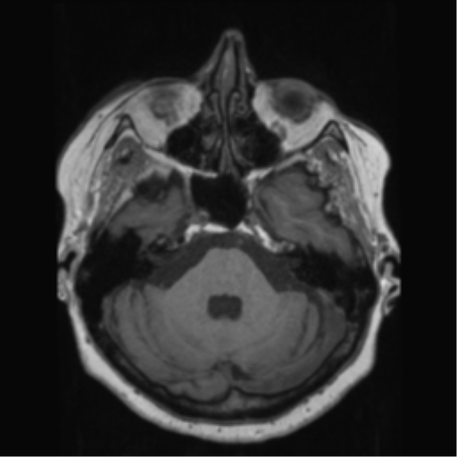 File:Anaplastic astrocytoma IDH wild-type (pseudoprogression) (Radiopaedia 42209-45278 Axial T1 50).png