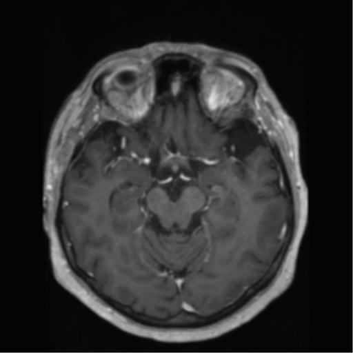 File:Anaplastic astrocytoma IDH wild-type (pseudoprogression) (Radiopaedia 42209-45278 Axial T1 C+ 67).png