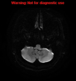 File:Anaplastic ganglioglioma (Radiopaedia 44921-48831 Axial DWI 4).jpg