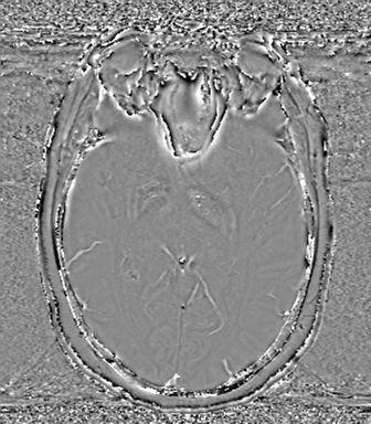Anaplastic oligodendroglioma (Radiopaedia 83500-98599 Axial SWI - phase 38).png