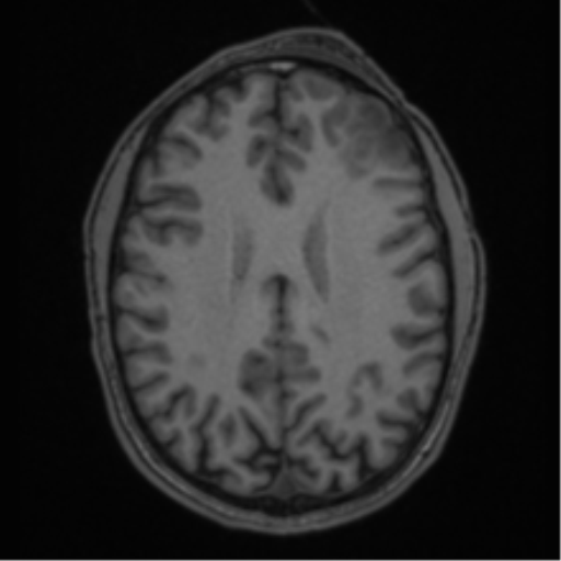 Anaplastic oligodendroglioma with skull fracture (Radiopaedia 74831-85845 Axial T1 41).png