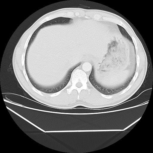 File:Aneurysmal bone cyst - rib (Radiopaedia 82167-96220 Axial lung window 54).jpg