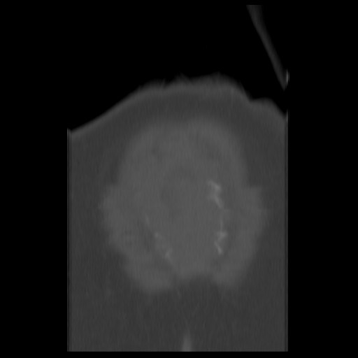 File:Aneurysmal bone cyst - sacrum (Radiopaedia 65190-74195 Coronal bone window 17).jpg