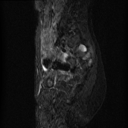 File:Aneurysmal bone cyst - sacrum (Radiopaedia 65190-74196 Sagittal STIR 22).jpg