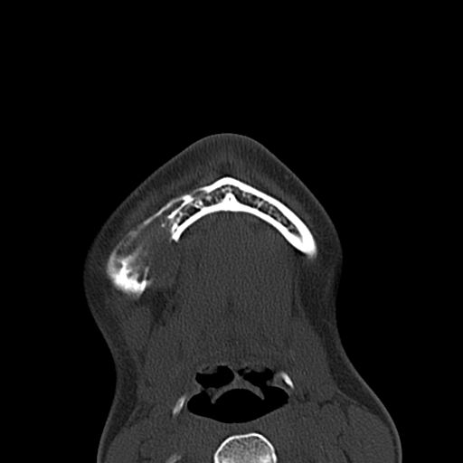 Aneurysmal bone cyst of the mandible (Radiopaedia 43280-46601 Axial bone window 5).jpg