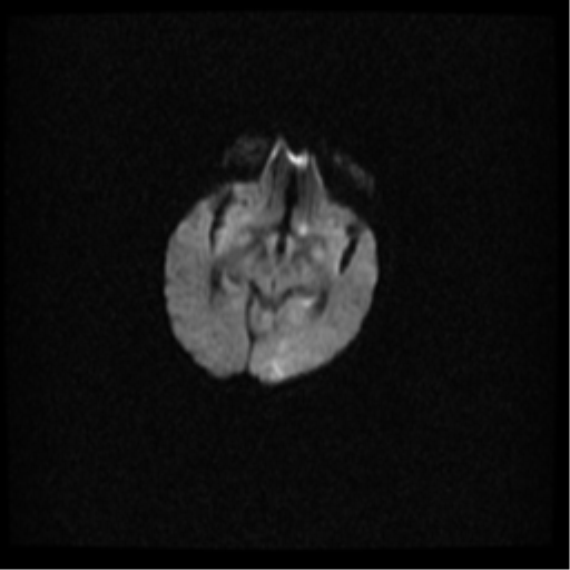 Angioinvasive aspergillosis in the pituitary fossa (Radiopaedia 39676-42010 Axial DWI 20).png