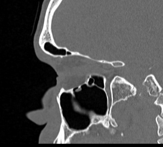 Angular epidermoid cyst (Radiopaedia 46908-51439 Sagittal bone window 60).png
