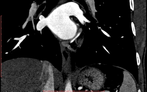 Anomalous left coronary artery from the pulmonary artery (ALCAPA) (Radiopaedia 70148-80181 B 224).jpg