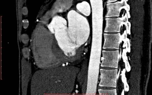 File:Anomalous left coronary artery from the pulmonary artery (ALCAPA) (Radiopaedia 70148-80181 C 126).jpg