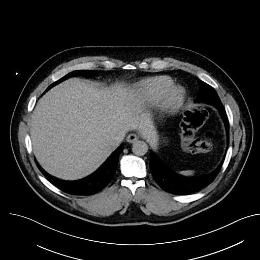 File:Anomalous origin of the left coronary artery with malignant course (Radiopaedia 77842-90126 Axial non-contrast 28).jpeg
