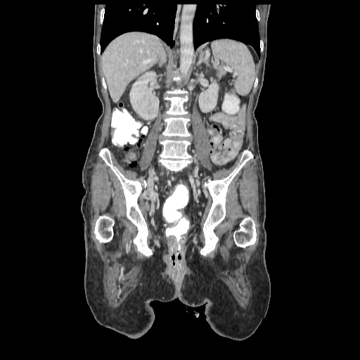 File:Anorectal carcinoma (Radiopaedia 44413-48064 B 52).jpg