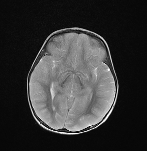 File:Anoxic brain injury (Radiopaedia 79165-92139 Axial T2 13).jpg