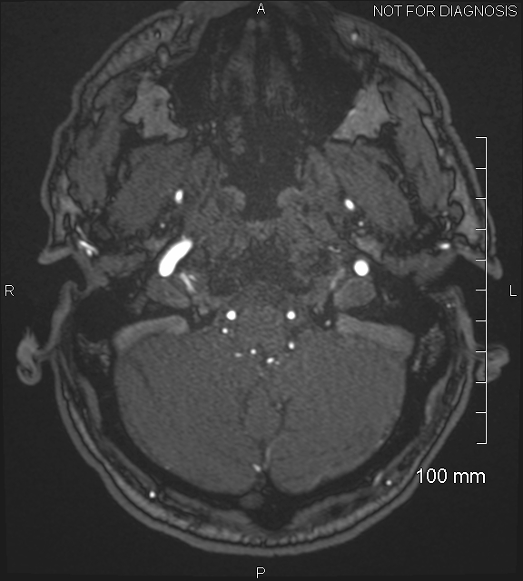 Anterior cerebral artery aneurysm (Radiopaedia 80683-94127 Axial MRA 24).jpg