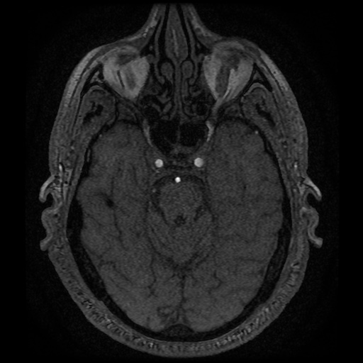 Anterior cerebral artery infarction (Radiopaedia 46794-51323 Axial MRA 52).jpg
