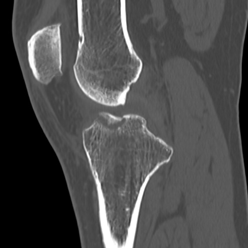 File:Anterior cruciate ligament avulsion fracture (Radiopaedia 58939-66194 Sagittal bone window 23).jpg