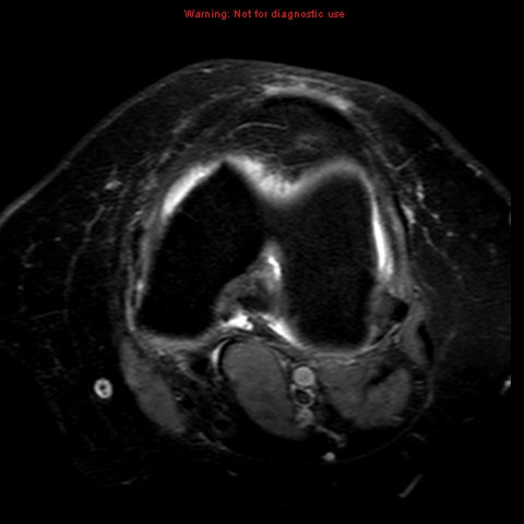 File:Anterior cruciate ligament tear (Radiopaedia 12329-12612 Axial T2 fat sat 11).jpg