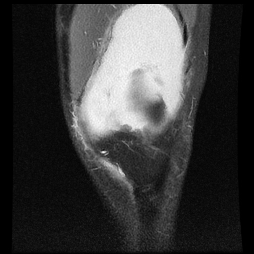 File:Anterior cruciate ligament tear (Radiopaedia 61500-69462 Coronal PD fat sat 4).jpg