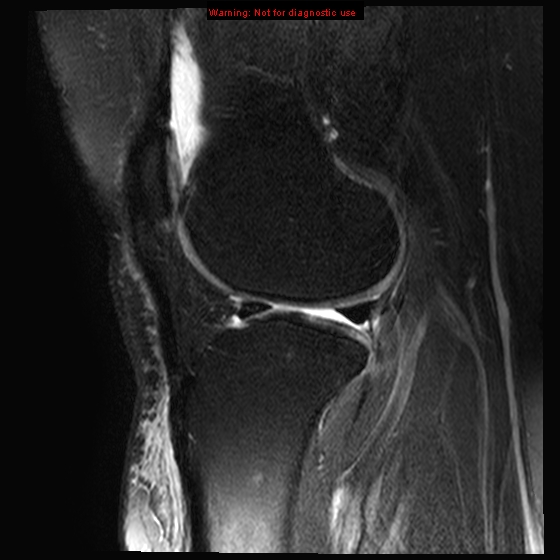 File:Anterior cruciate ligament tear - complete (Radiopaedia 12175-12514 Sagittal T2 fat sat 7).jpg