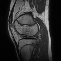 Anterior cruciate ligament tear - pediatric (Radiopaedia 62152-70260 Sagittal PD 123).jpg