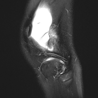 File:Anterior cruciate ligament tear - pediatric (Radiopaedia 62152-70260 Sagittal PD fat sat 31).jpg