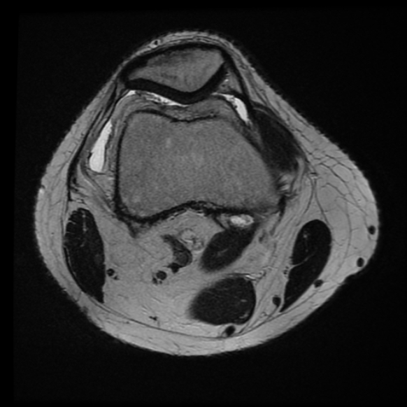 File:Anterior cruciate ligament tear with posteromedial corner injury, bucket-handle meniscal tear and chondral delamination (Radiopaedia 75501-86744 Axial T2 21).jpg