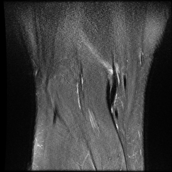 File:Anterior cruciate ligament tear with posteromedial corner injury, bucket-handle meniscal tear and chondral delamination (Radiopaedia 75501-86744 Coronal PD fat sat 24).jpg