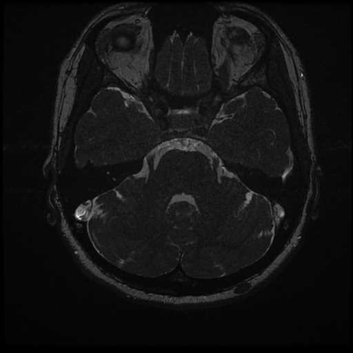 Anterior inferior cerebellar artery vascular loop - type II (Radiopaedia 70991-81209 Axial 3D FIESTA 18).jpg