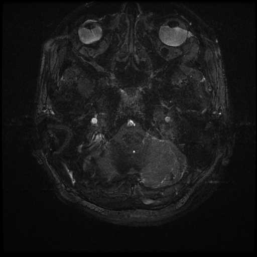 Anterior inferior cerebellar artery vascular loop - type II (Radiopaedia 70991-81209 Axial 3D FIESTA 79).jpg