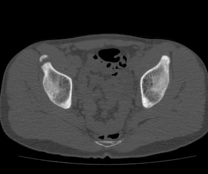 Anterior inferior iliac spine avulsion fracture (Radiopaedia 81312-94999 Axial bone window 47).jpg