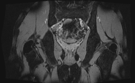 Anterior inferior iliac spine avulsion fracture (Radiopaedia 81312-95000 G 13).jpg