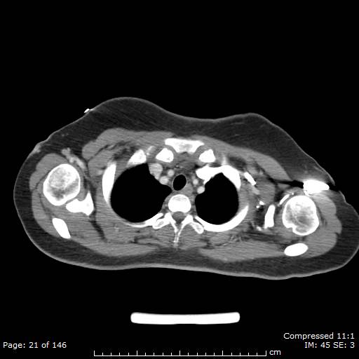 Anterior mediastinal B cell Lymphoma (Radiopaedia 50677-56114 A 11).jpg