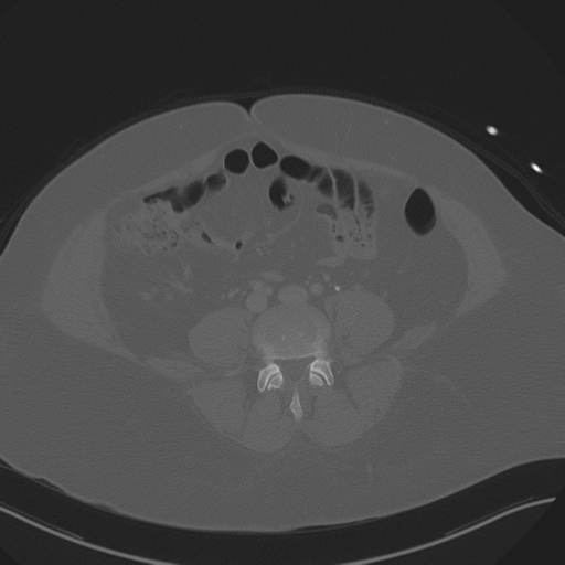 Anterior superior iliac spine avulsion fracture (Radiopaedia 44541-48244 Axial bone window 65).png