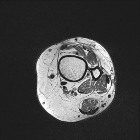 File:Anterior talofibular ligament injury - rupture with soft-tissue impingement (Radiopaedia 38765-40928 Axial PD 2).jpg