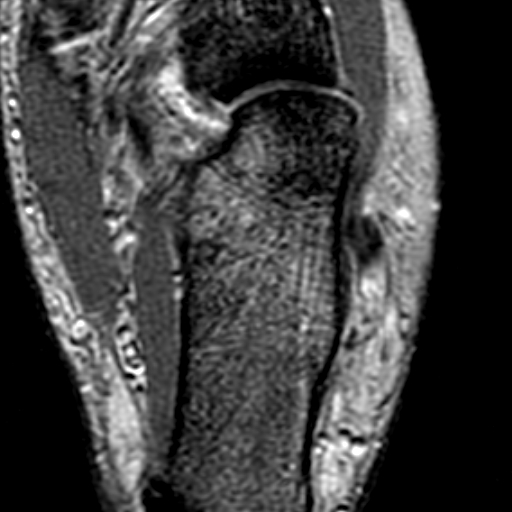 File:Anterior talofibular ligament rupture (Radiopaedia 15831-15484 Axial T2* 19).jpg