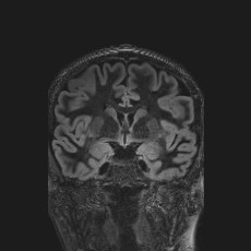 Anterior temporal encephalocele (Radiopaedia 82624-96808 Coronal FLAIR 22).jpg