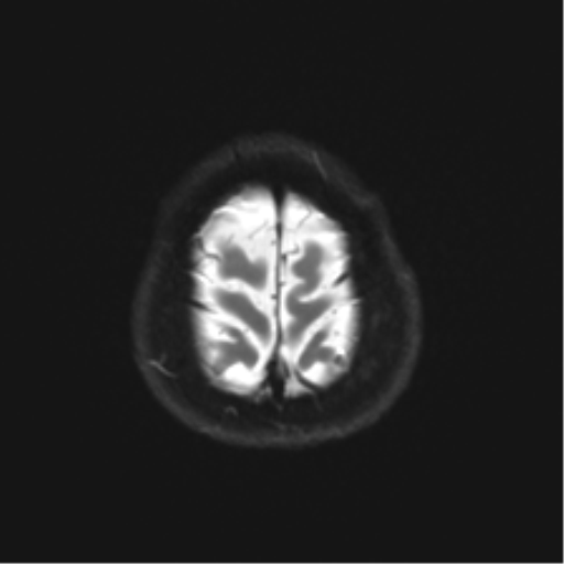 Anterior temporal lobe perivascular space (Radiopaedia 40946-43650 Axial DWI 26).png