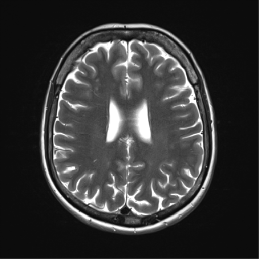 File:Anterior temporal lobe perivascular space (Radiopaedia 40946-43650 Axial T2 25).png