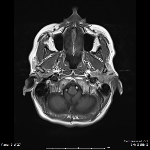 File:Anterior temporal lobe perivascular space (Radiopaedia 88283-104914 Axial T1 5).jpg