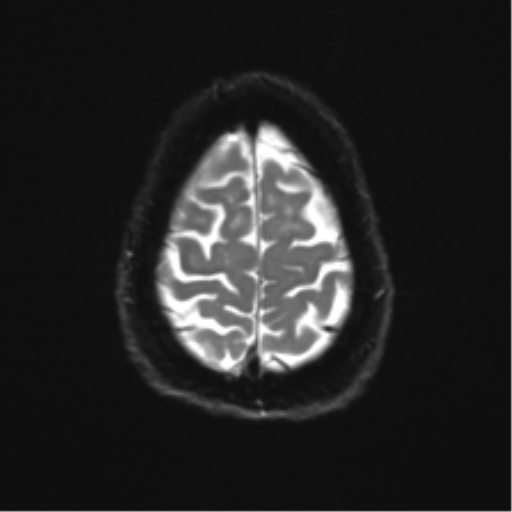 File:Anterior temporal pole cysts (Radiopaedia 46629-51102 Axial DWI 24).png