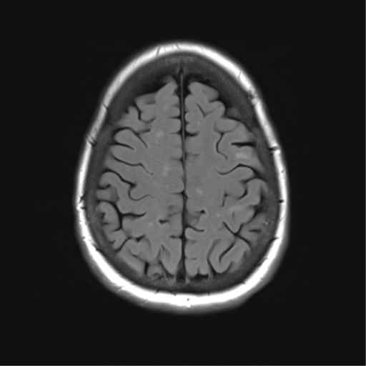 File:Anterior temporal pole cysts (Radiopaedia 46629-51102 Axial FLAIR 22).png