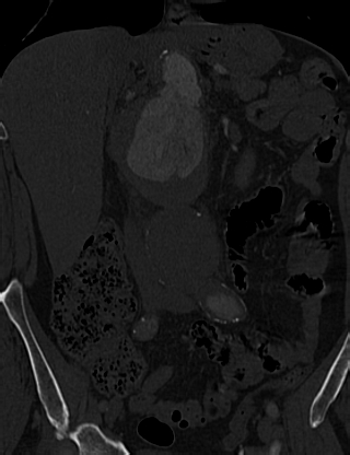 Anterior vertebral scalloping (abdominal aortic aneurysm) (Radiopaedia 66744-76067 Coronal bone window 16).jpg