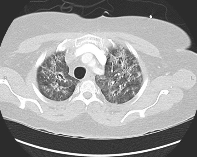 Anti-synthetase syndrome (anti-Jo1) (Radiopaedia 31899-32846 Axial lung window 10).JPG