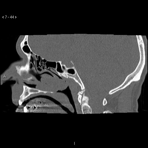 File:Antrochoanal Polyp (Radiopaedia 70510-80631 Sagittal bone window 34).jpg