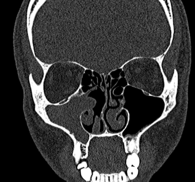 Antrochoanal polyp (Radiopaedia 30002-30554 Coronal bone window 35).jpg